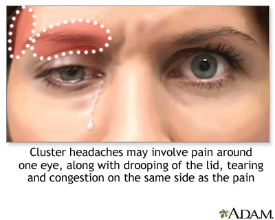 Can cluster headaches be cured?